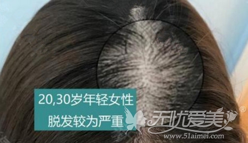 压力大出现脱发？在韩国无需手术头皮纹身SMP就能帮你改善