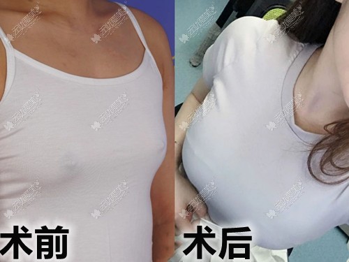 乳房表面长透明小水珠图片