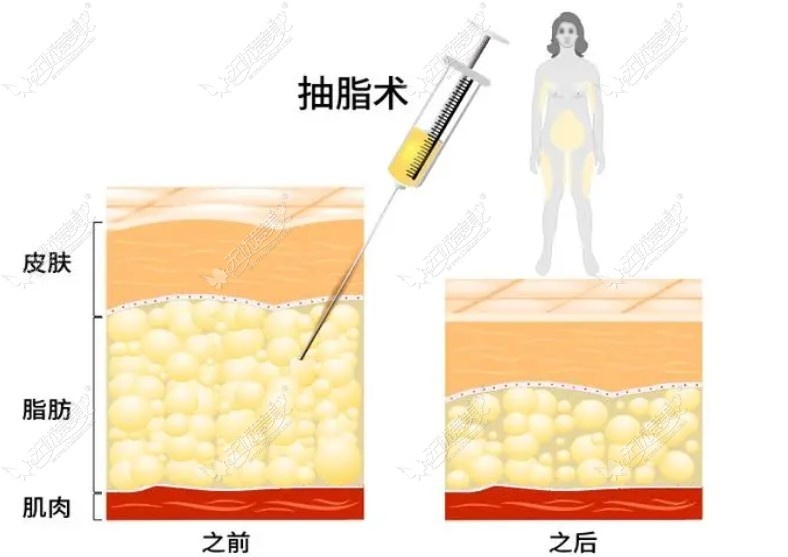 成都排名前三吸脂医生名单医生吸脂前后变化图