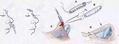 自体肋骨隆鼻过程