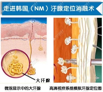 韩国NM汗腺定位消融术.JPG