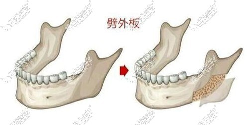 劈外板的原理