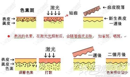 激光去老年斑的原理