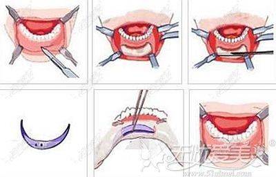 假体垫下巴手术的过程