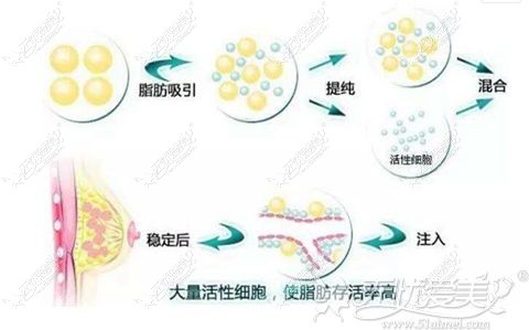 自体脂肪丰胸过程