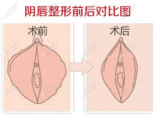 湛江澳泰阴唇整形