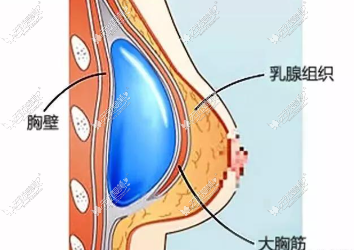 宜宾假体隆胸手术贵不