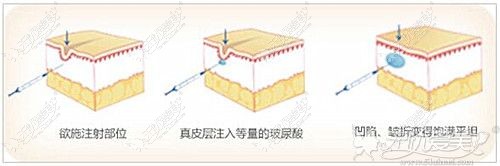 注射玻尿酸填充额头的过程