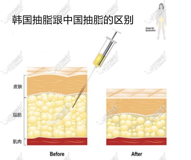 韩国抽脂和中国抽脂的区别