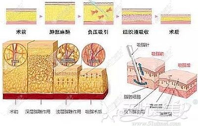 泸州韩美大腿吸脂的原理