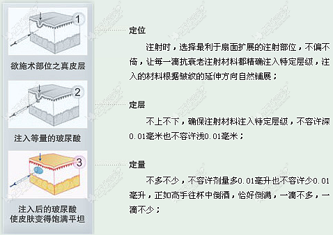 注射伊婉玻尿酸图解