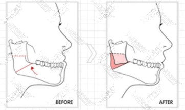 下巴线条调整截骨术