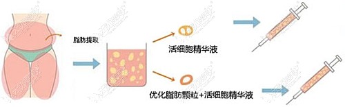 自体脂肪隆下巴