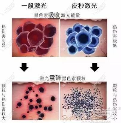 石家庄雅芳亚皮秒激光祛黄褐斑优势