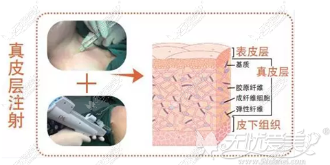 嗨体去除颈纹的原理