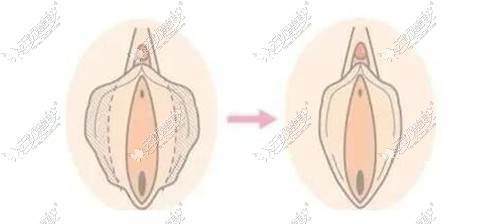 小阴唇肥大手术切除效果对比