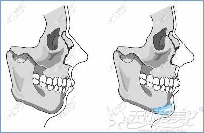 沈阳安娜宝士丰下巴改善凸嘴