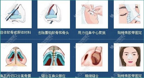 深圳鹏爱明星隆鼻手术