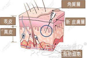 PPDO可注入真皮层