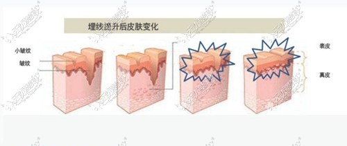 恢复后还有凹陷情况就是失败了