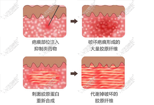 注射软化针的原理