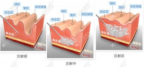 瘦脸除皱注射除皱原理