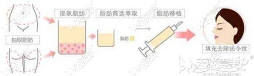 自体脂肪移植去法令纹手术过程