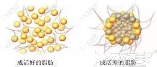 自体脂肪移植细胞存活效果对比