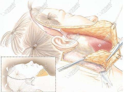 大拉皮手术切口
