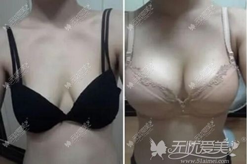 胸外扩矫正手术前后