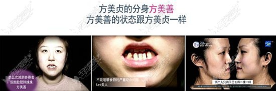 面部轮廓 双鄂手术