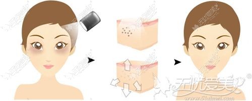 激光去黑眼圈的手术原理