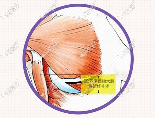 5D内窥镜隆胸原理