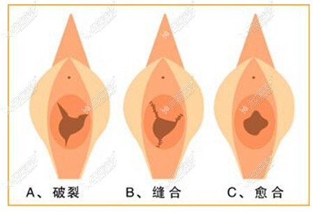 百佳东方处女膜修复手术