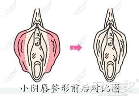 小阴唇缩小手术的效果