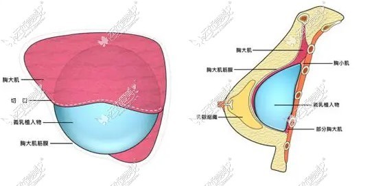 出彩医美十分钟隆胸技术原理及优势