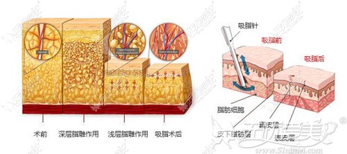 韩式分层吸脂紧肤术瘦身原理