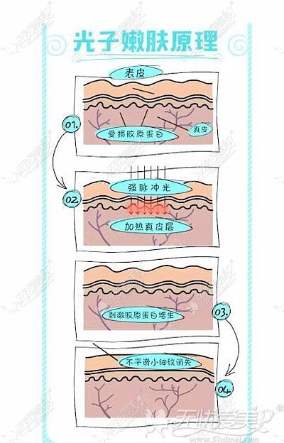 M22光子嫩肤的美肤原理