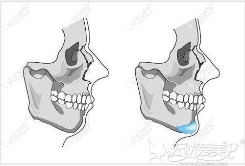钻石T字截骨可同时解决下巴问题