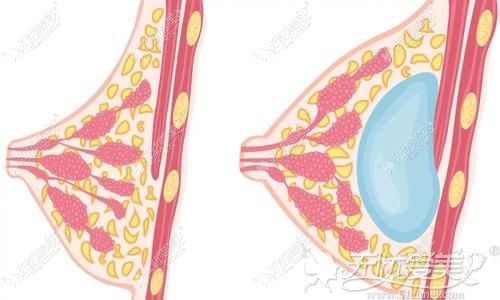 做假体隆胸手术可以增大罩杯
