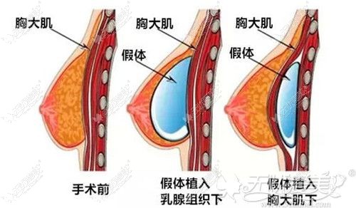 隆胸假体放置的乳房位置