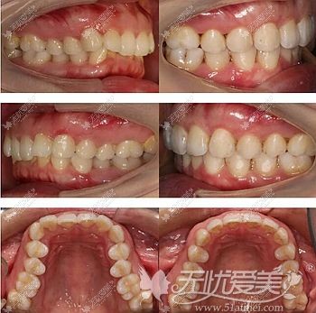 戴隐秀隐形牙套后牙齿的改善