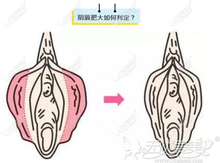 阴唇肥大和正常阴唇的区别