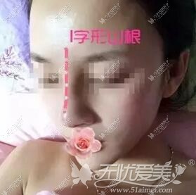 周口缔莱美假体隆鼻术后3天