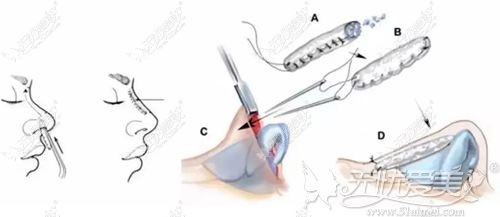 肋骨隆鼻的手术过程