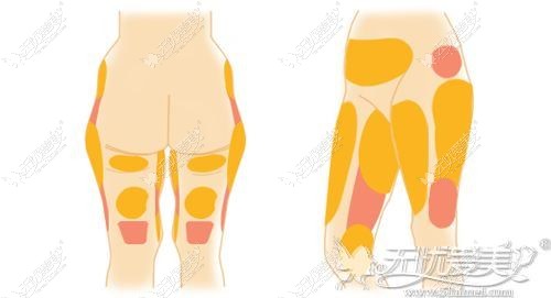 大腿吸脂手术的部位