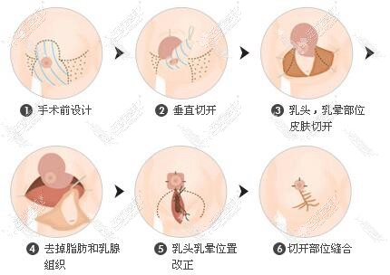 南京韩辰乳房缩小术