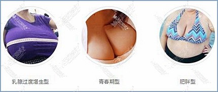 乳房肥大三种类型