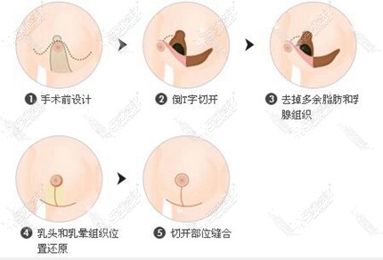 南京韩辰乳房缩小术方法