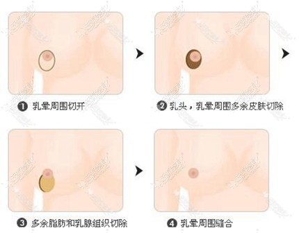 南京韩辰乳房缩小